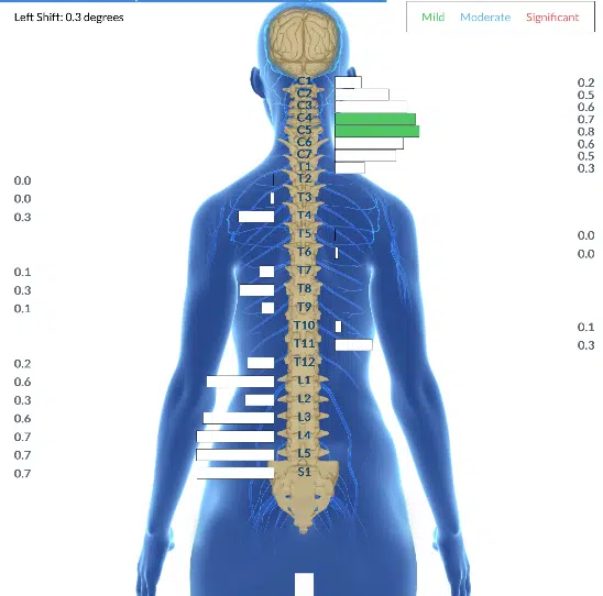 From Unrelenting Heartburn and Sciatic Pain to Minimal Symptoms and Feeling Great | PX Docs