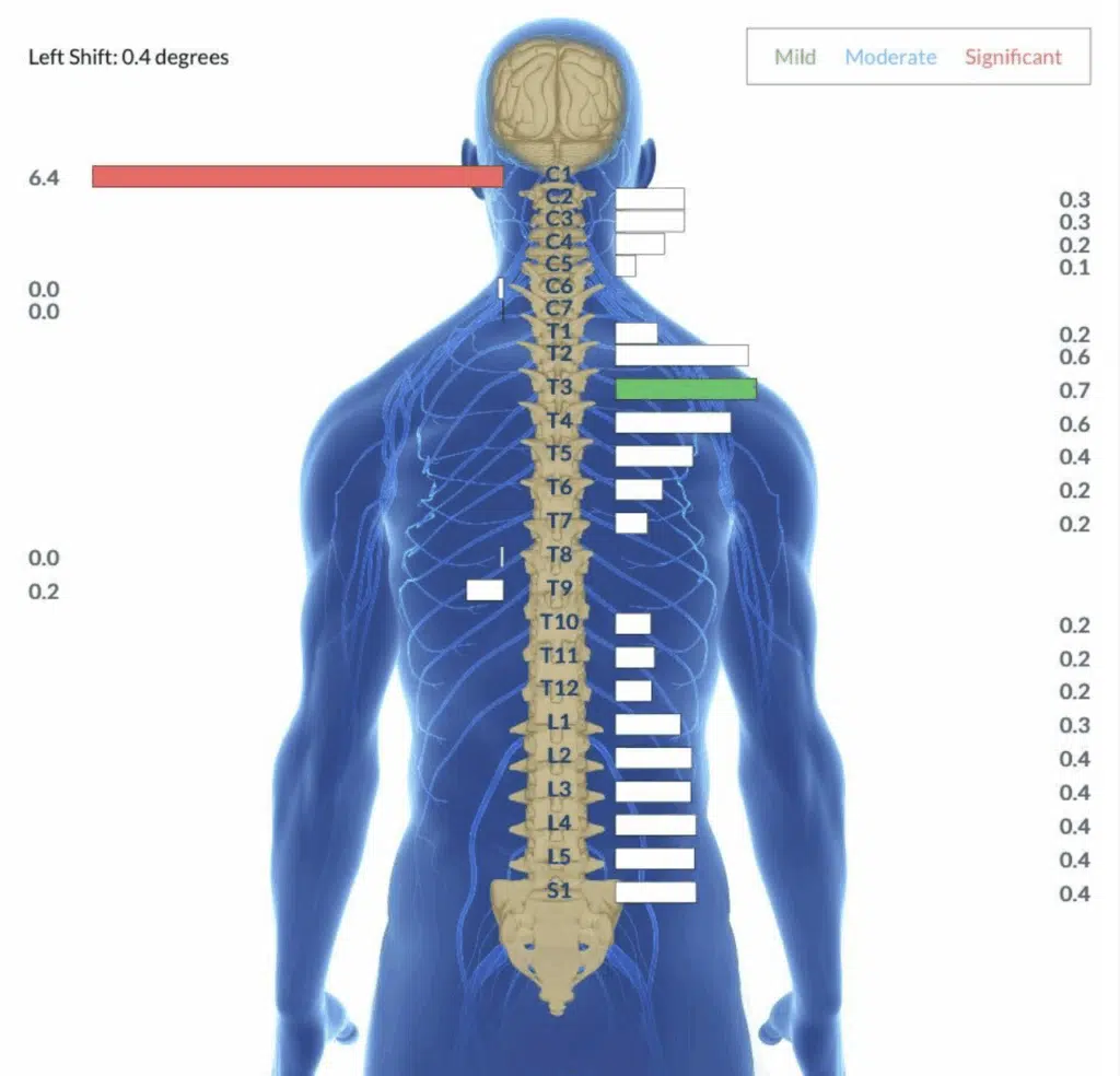 From Strugging with Torticollis, Discomfort and Fussiness to Happy, Healthy and Very Mobile | PX Docs
