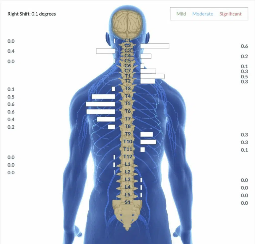 From Strugging with Torticollis, Discomfort and Fussiness to Happy, Healthy and Very Mobile | PX Docs