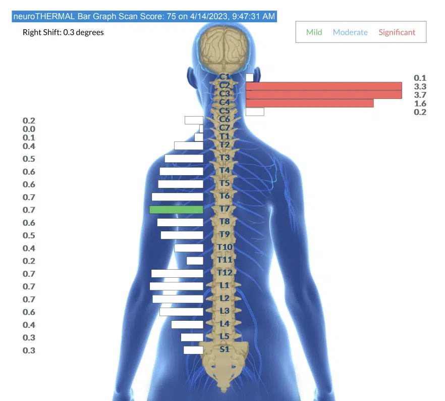 Why Primary Subluxation Patterns Reappear During Care | PX Docs